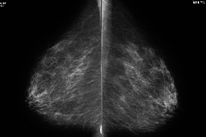 イメージ｜左の乳房に乳がんが写っているマンモグラフィーの一例